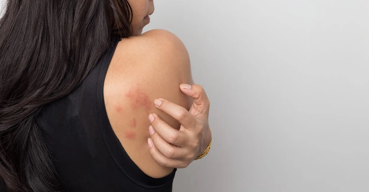 how does bed bug bites look