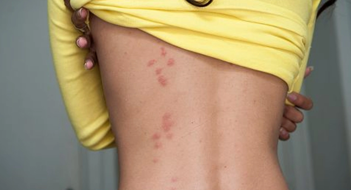 how does a bedbug bite looks